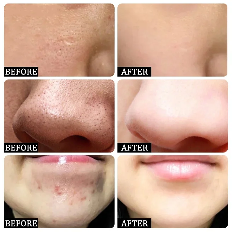 Krim Pembersih Pori Asam Salis - Skincare Korea ulasan dan harga