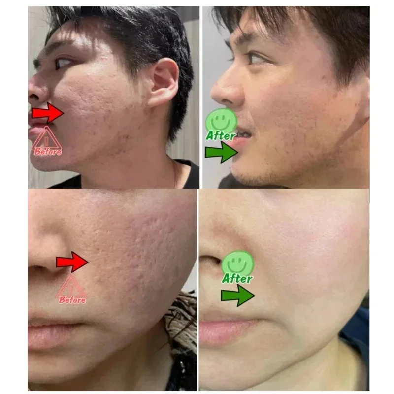Krim Pembersih Pori Asam Salis - Skincare Korea ulasan dan harga